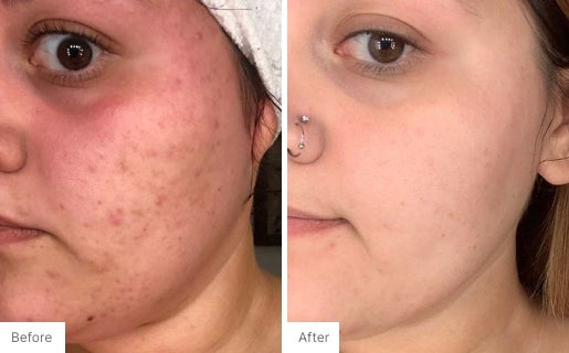 Acne Real Results Image 3